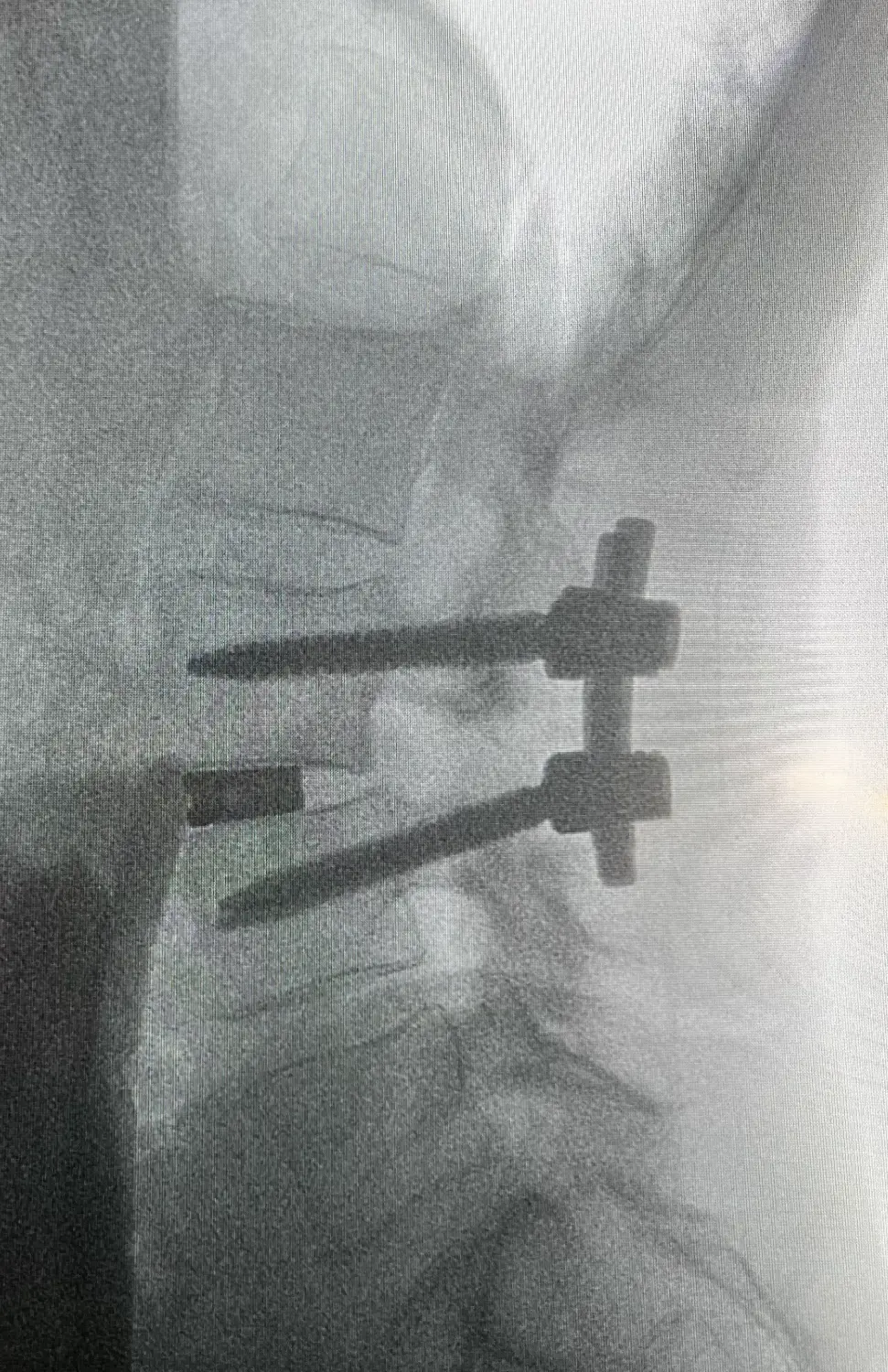 Osteochondrose (Spondylodese) von Dr. Wanke Ortho.Spine